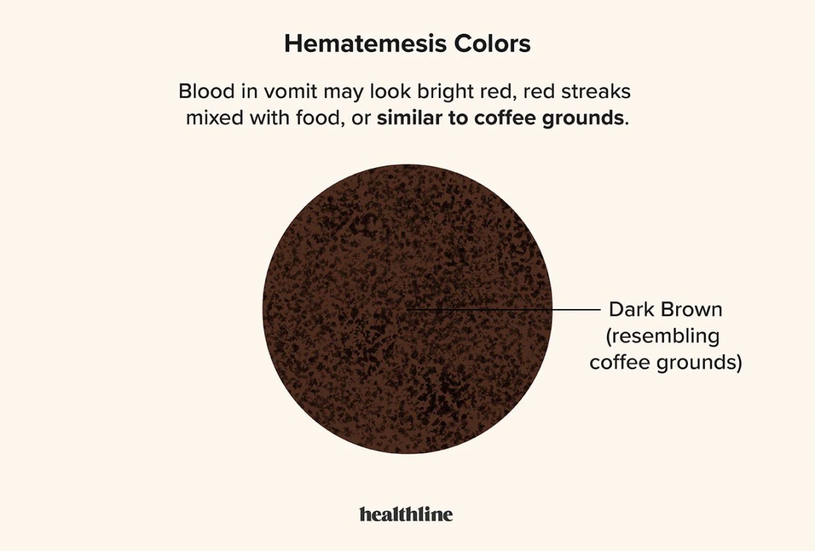 Coffee Ground Emesis: Understanding Coffee-related Vomiting